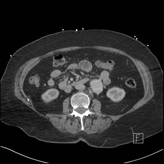 Aortic intramural hematoma with dissection and intramural blood pool (Radiopaedia 77373-89491 E 38).jpg