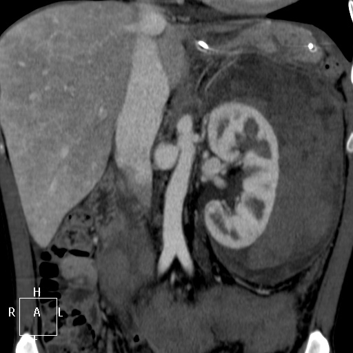 Aorto-left renal vein fistula (Radiopaedia 45534-49628 B 31).jpg