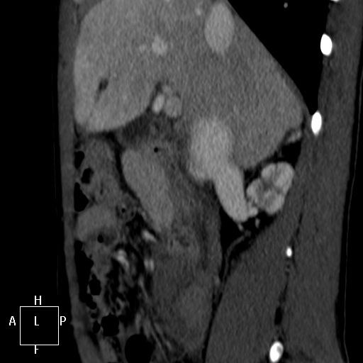 Aorto-left renal vein fistula (Radiopaedia 45534-49628 C 11).jpg