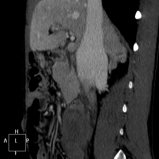 Aorto-left renal vein fistula (Radiopaedia 45534-49628 C 16).jpg