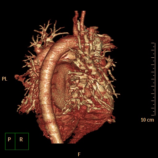 File:Aortopulmonary septal defect (Radiopaedia 41990-45013 3D reconstruction 14).jpg