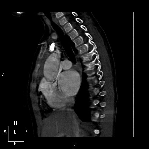 File:Aortopulmonary septal defect (Radiopaedia 41990-45013 Sagittal C+ CTPA 33).jpg