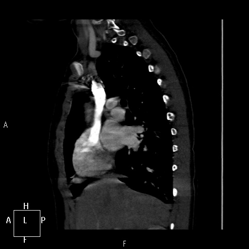 File:Aortopulmonary septal defect (Radiopaedia 41990-45013 Sagittal C+ CTPA 39).jpg