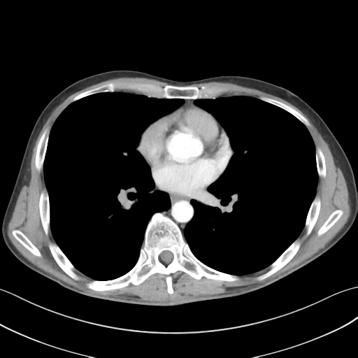 File:Apical pleural calcification (Radiopaedia 46141-50499 Axial C+ delayed 38).png
