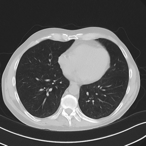 Apical pulmonary metastasis (Radiopaedia 46338-50754 Axial non-contrast 43).png