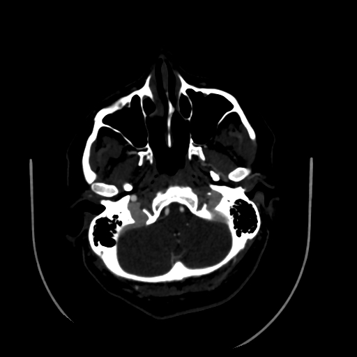 File:Aplasia of the internal carotid artery (Radiopaedia 61082-68960 A 12).jpg
