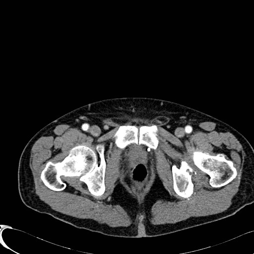 File:Appendiceal adenocarcinoma complicated by retroperitoneal abscess (Radiopaedia 58007-65039 B 142).jpg