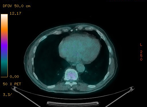 Appendiceal adenocarcinoma complicated by retroperitoneal abscess (Radiopaedia 58007-65041 Axial PET-CT 88).jpg