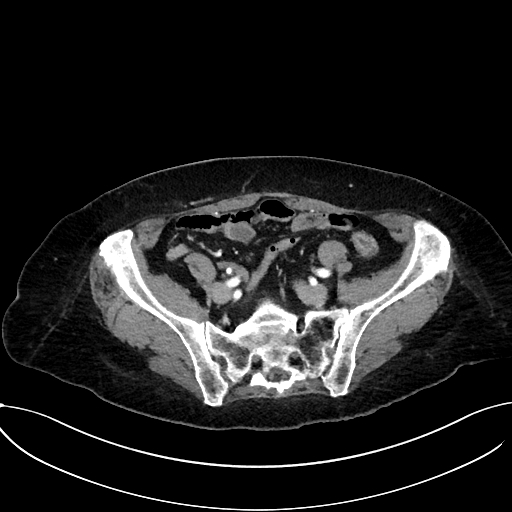 Appendiceal hemorrhage (Radiopaedia 70830-81025 A 94).jpg