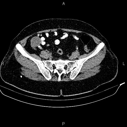 Appendiceal mucocele (Radiopaedia 83147-97518 A 31).jpg