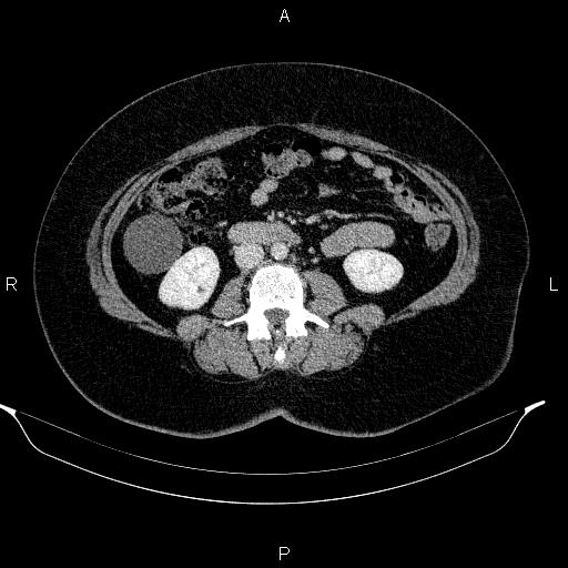 Appendiceal mucocele (Radiopaedia 83280-97688 Axial With contrast 56).jpg