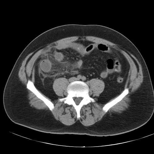 File:Appendicitis and giant appendicolith (Radiopaedia 80251-93588 Axial non-contrast 37).jpg