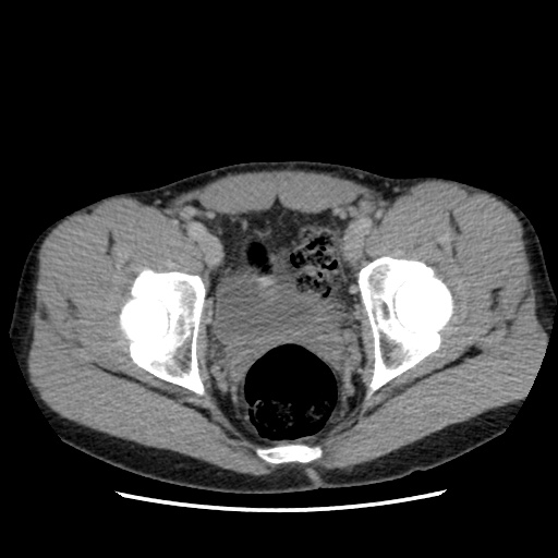 File:Appendicitis complicated by post-operative collection (Radiopaedia 35595-37113 A 72).jpg