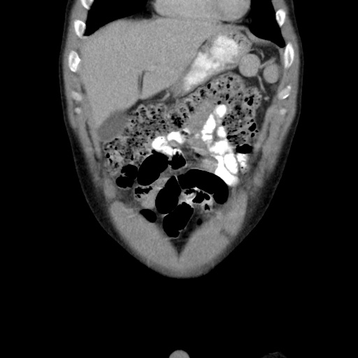 File:Appendicitis complicated by post-operative collection (Radiopaedia 35595-37113 B 14).jpg