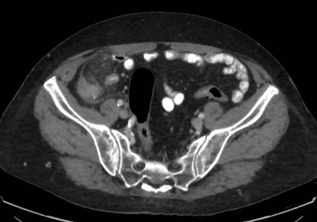 File:Appendicitis due to chicken fibula (Radiopaedia 74314-85198 A 29).jpg