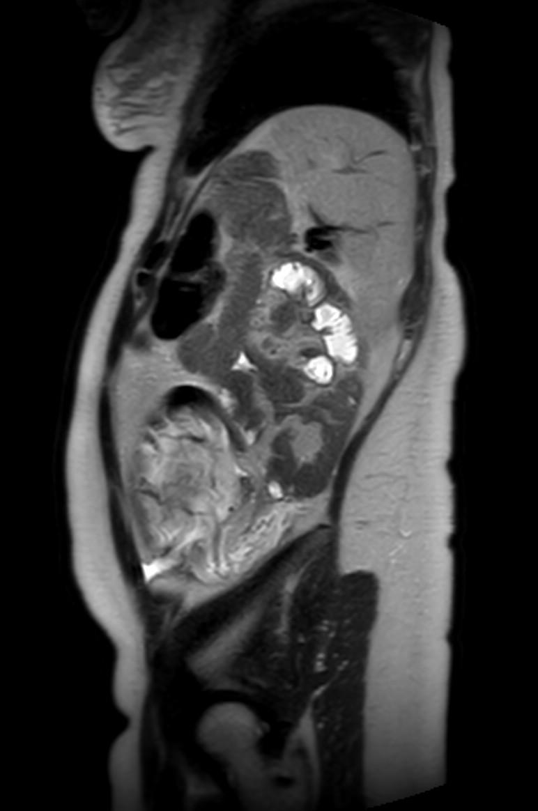 Appendicitis in gravida (MRI) (Radiopaedia 89433-106395 Sagittal T2 15).jpg