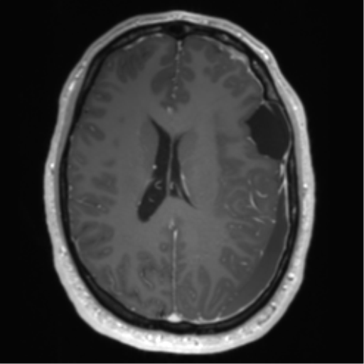 Arachnoid cyst with subdural hematoma (Radiopaedia 85892-101743 Axial T1 C+ 53).png