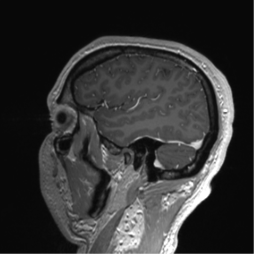 Arachnoid cyst with subdural hematoma (Radiopaedia 85892-101743 Sagittal T1 C+ 74).png