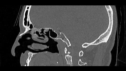 File:Arcuate foramen (Radiopaedia 89833-106944 Sagittal bone window 44).jpg