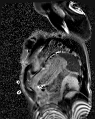 File:Arrhythmogenic right ventricular cardiomyopathy (Radiopaedia 57972-64966 D 12).jpg