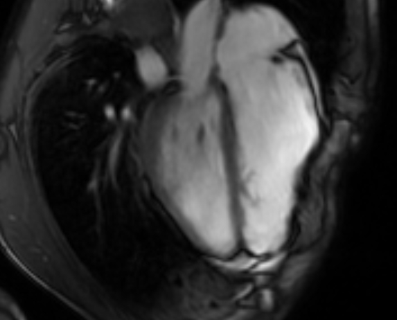 Arrhythmogenic right ventricular cardiomyopathy (Radiopaedia 69564-79464 4ch cine 93).jpg