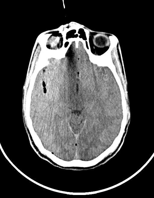 Arrow injury to the brain (Radiopaedia 72101-82607 Axial non-contrast 68).jpg