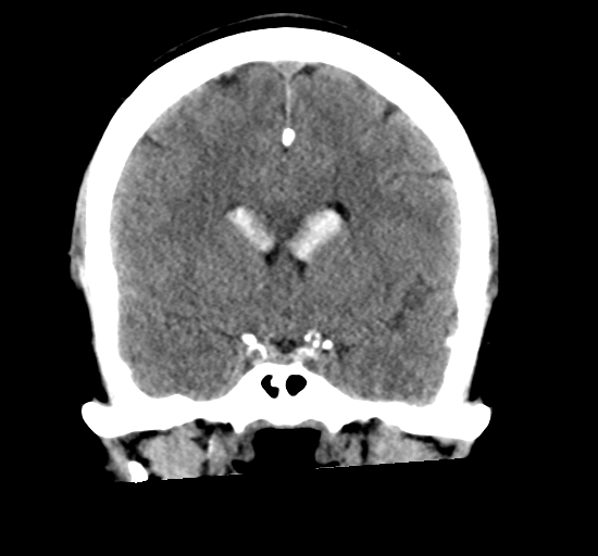 File:Arteriovenous malformation (cerebral) (Radiopaedia 40070-42579 Coronal non-contrast 16).png