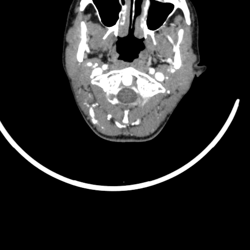 File:Arteriovenous malformation of the neck (Radiopaedia 53935-60062 A 57).jpg