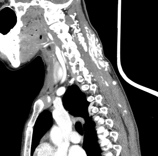 File:Arteriovenous malformation of the neck (Radiopaedia 53935-60062 C 50).jpg
