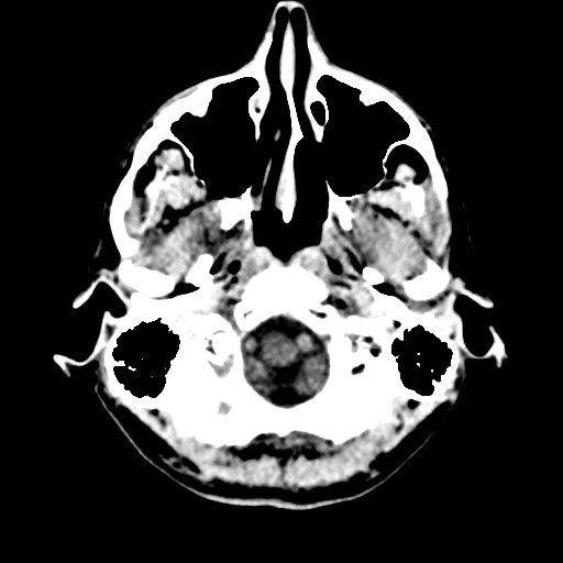 File:Artery of Percheron infarct (Radiopaedia 48088-52893 Axial non-contrast 2).jpg
