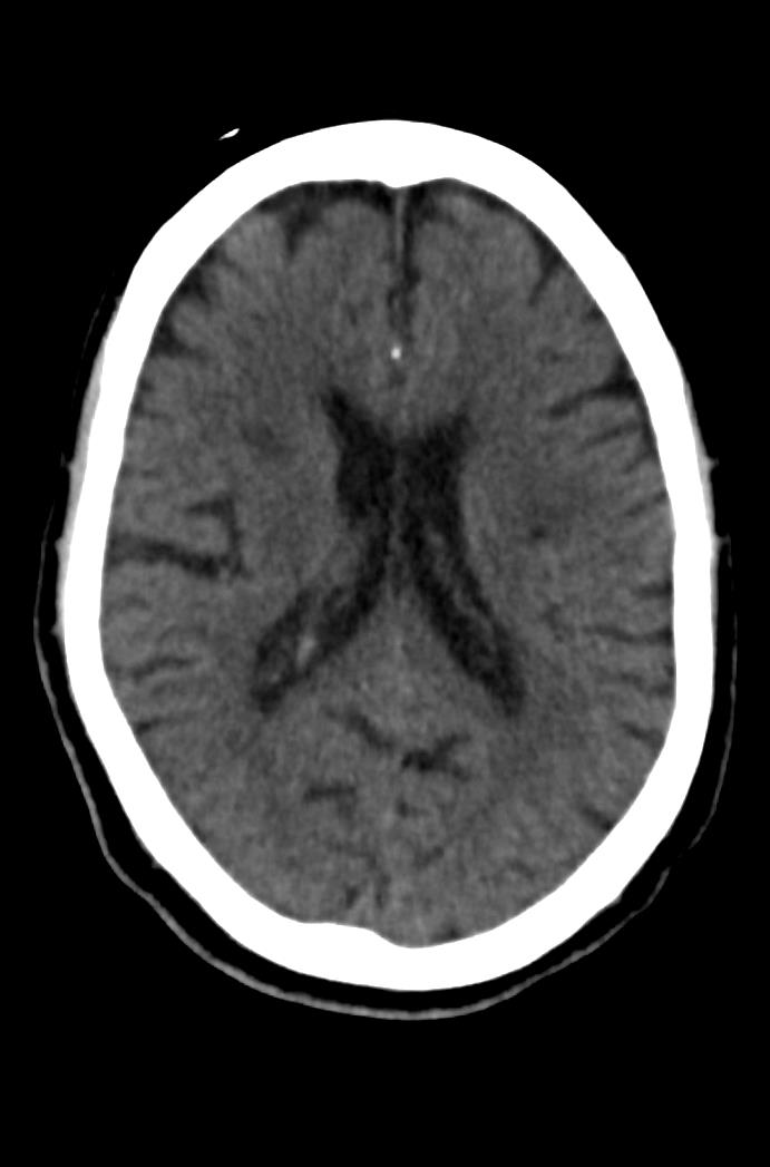 Artery of Percheron infarction (Radiopaedia 80613-94202 Axial non-contrast 114).jpg