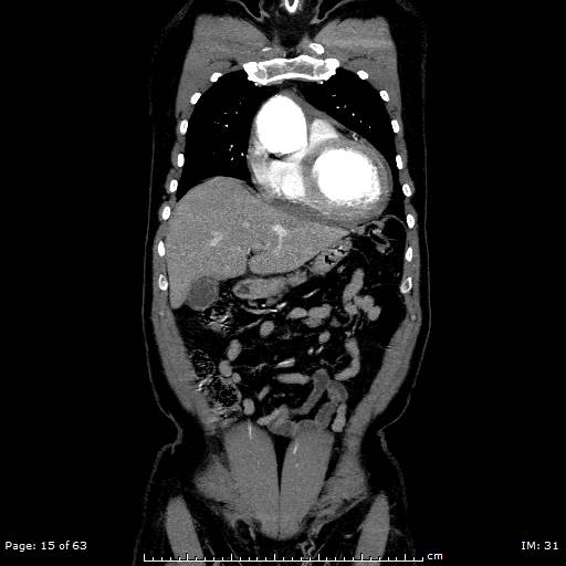 Ascending aortic aneurysm (Radiopaedia 50086-55404 B 15).jpg