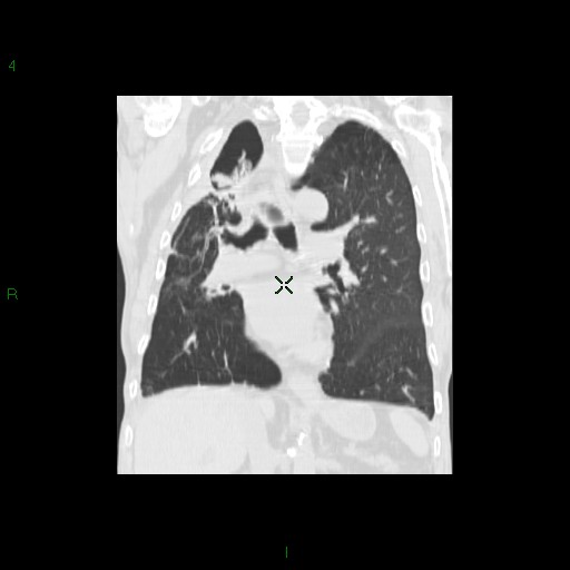 File:Aspergilloma (Radiopaedia 14842-14787 Coronal lung window 19).jpg