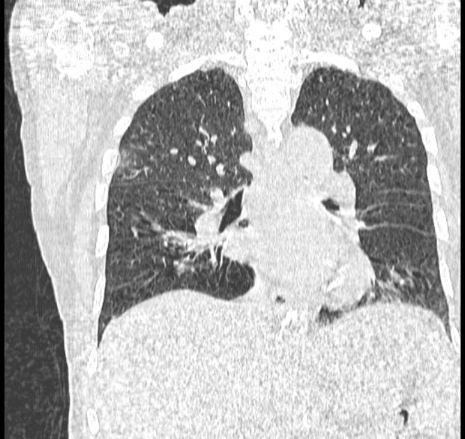 Aspergilloma (Radiopaedia 44592-48327 Coronal lung window 75).jpg