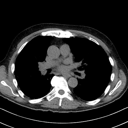 Aspergilloma on background pulmonary fibrosis (Radiopaedia 60942-68757 Axial non-contrast 30).jpg
