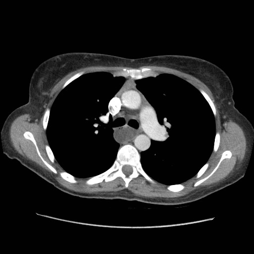 File:Aspiration pneumonia secondary to laparoscopic banding (Radiopaedia 18345-18183 A 18).jpg