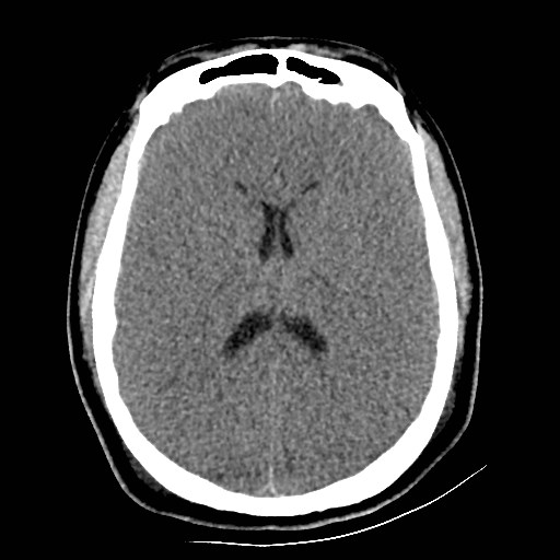 Atlanto-occipital dislocation (Radiopaedia 44648-48412 Axial non-contrast 32).jpg