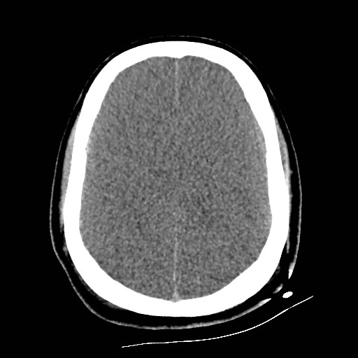 Atlanto-occipital dislocation (Radiopaedia 44648-48412 Axial non-contrast 40).jpg