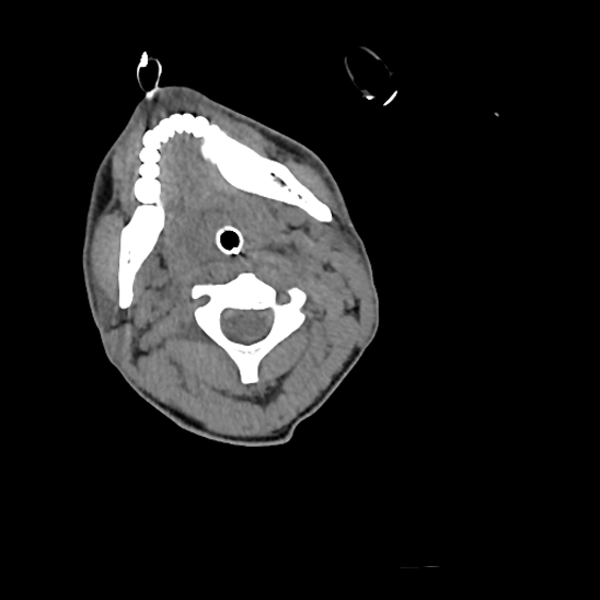 File:Atlanto-occipital dissociation (Traynelis type 1), C2 teardrop fracture, C6-7 facet joint dislocation (Radiopaedia 87655-104061 Axial non-contrast 25).jpg