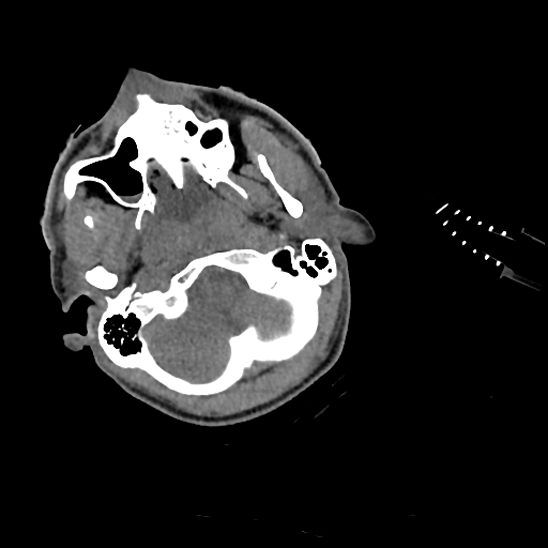 File:Atlanto-occipital dissociation (Traynelis type 1), C2 teardrop fracture, C6-7 facet joint dislocation (Radiopaedia 87655-104061 Axial non-contrast 4).jpg