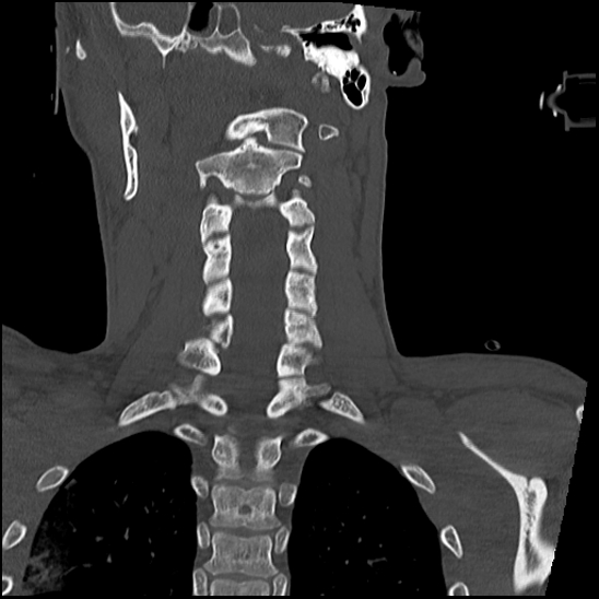 Atlanto-occipital dissociation (Traynelis type 1), C2 teardrop fracture, C6-7 facet joint dislocation (Radiopaedia 87655-104061 Coronal bone window 41).jpg
