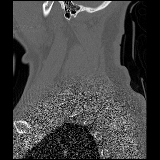 File:Atlanto-occipital dissociation injury (Radiopaedia 29274-29698 Sagittal bone window 52).png