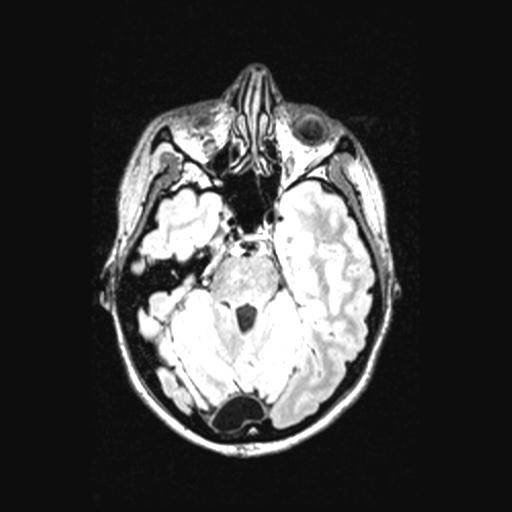 Atretic encephalocoele with inferior vermis hypoplasia (Radiopaedia 30443-31108 Axial 54).jpg
