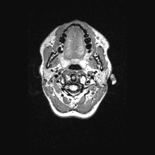 Atretic encephalocoele with inferior vermis hypoplasia (Radiopaedia 30443-31108 Axial 7).jpg