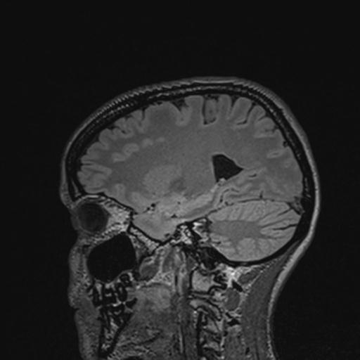 Atretic encephalocoele with inferior vermis hypoplasia (Radiopaedia 30443-31108 Sagittal FLAIR 104).jpg
