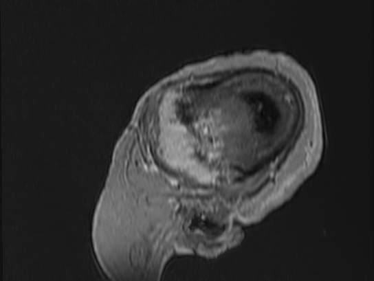 Atypical meningioma (Radiopaedia 62985-71406 Sagittal T1 C+ 97).jpg
