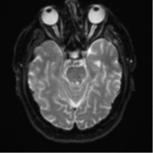 Atypical meningioma (WHO grade II) with brain invasion (Radiopaedia 57767-64729 Axial DWI 10).png