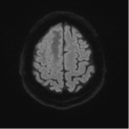 Atypical meningioma (WHO grade II) with brain invasion (Radiopaedia 57767-64729 Axial DWI 55).png