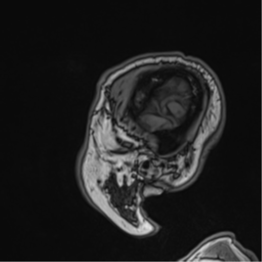 File:Atypical meningioma (WHO grade II) with brain invasion (Radiopaedia 57767-64729 Sagittal T1 13).png