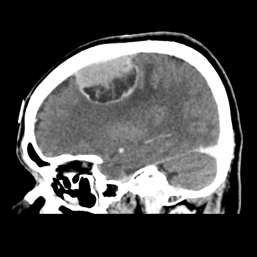 File:Atypical meningioma (WHO grade II) with osseous invasion (Radiopaedia 53654-59715 G 18).png